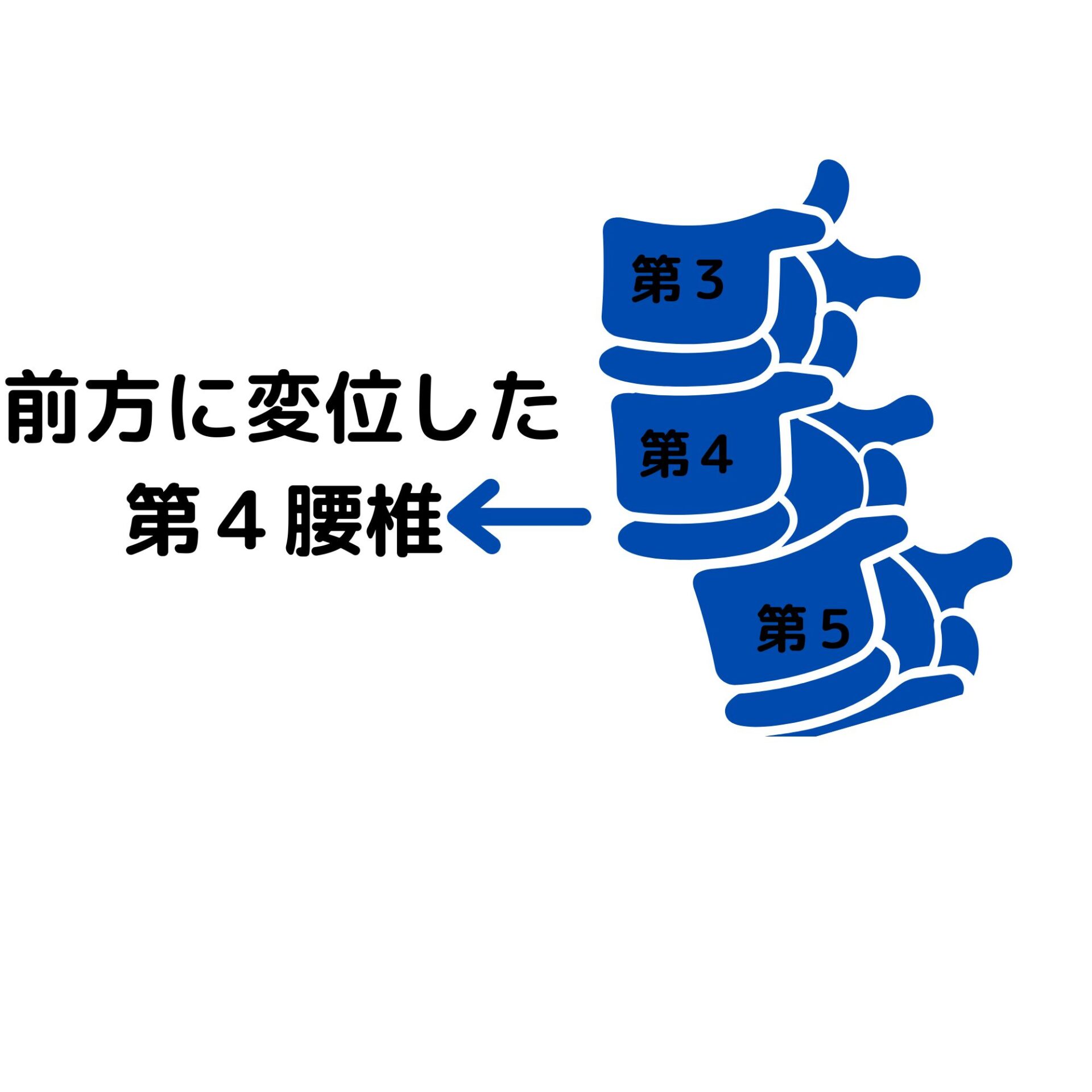 前方に変位した-第４腰椎　腰椎すべり症　滋賀県大津市　あゆは整体院